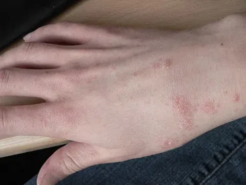 Dấu hiệu nhận biết bạn đang bị ghẻ