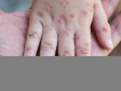 Một người có thể mắc sởi 2 lần không?