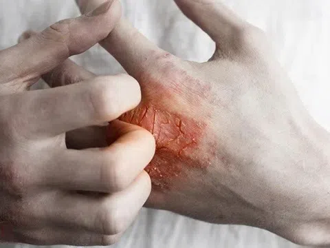 Các loại chàm thường gặp