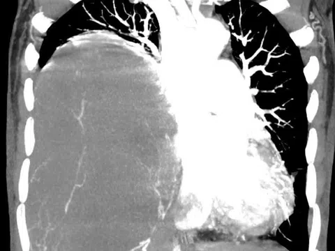 Từ chối điều trị, sau một năm khối u phát triển nặng 2kg đè xẹp phổi