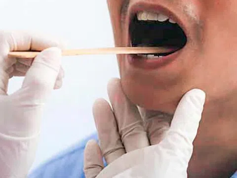 Ung thư lưỡi là căn bệnh nguy hiểm, ai có nguy cơ mắc?