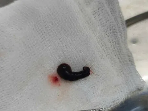 Con vắt dài 4 cm sống trong mũi người phụ nữ suốt 3 ngày