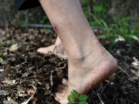 Hay đi chân đất, người phụ nữ ở TP.HCM nhiễm khuẩn 'ăn thịt người'