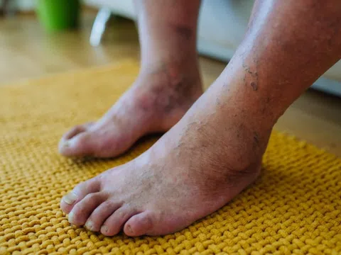 4 biến chứng nặng nề của bệnh tiểu đường