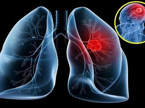 Người bệnh ung thư phổi nên ăn và tránh thực phẩm nào?