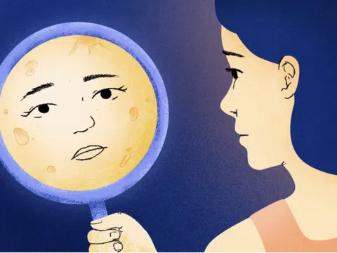 Căng thẳng có thể làm gương mặt sưng lên như 'mặt trăng'?