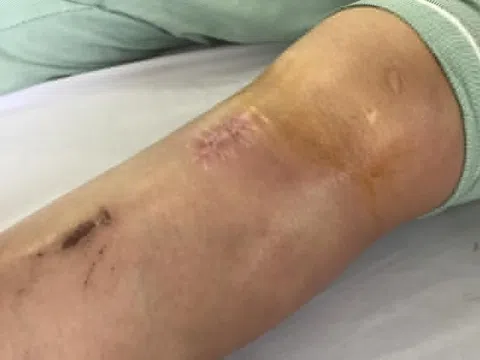 Sai lầm khi chữa đau khớp khiến thanh niên 24 tuổi nhập viện