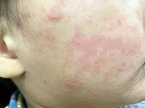 Nhận biết ban do sởi hay phát ban do vi rút