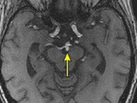 Làm sao để phát hiện phình động mạch não và khi nào cần điều trị?