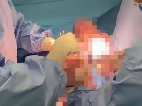 Em bé được bọc trong khối u xơ 8kg ra đời khỏe mạnh