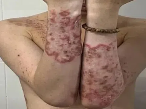 Tự ý điều trị ngứa, nam thanh niên bị nấm mọc toàn thân
