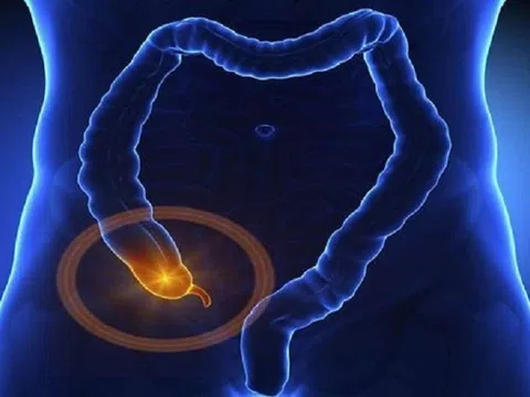 Đau bụng âm ỉ, đau bụng quanh rốn cảnh giác với viêm ruột thừa