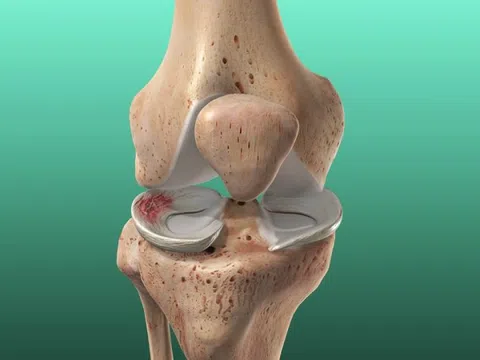 Dùng thuốc nào điều trị chấn thương sụn chêm?