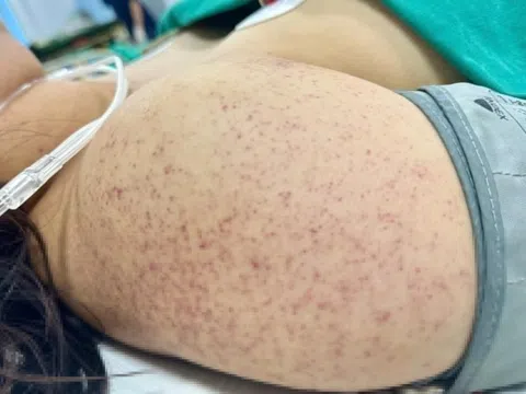 Căng thẳng ca đỡ sinh cho thai phụ sốt xuất huyết bất ngờ chuyển dạ