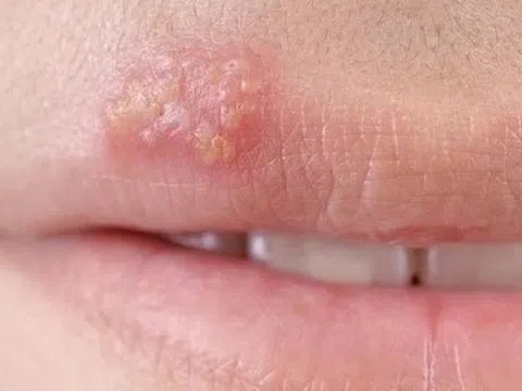 Cách phòng tránh lây nhiễm Herpes sinh dục