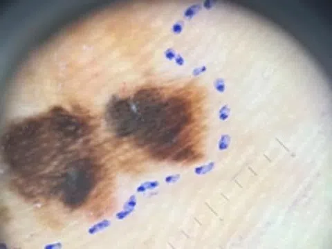 Quy tắc dễ nhớ giúp phát hiện sớm ung thư da