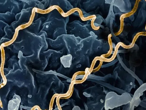 Bệnh giang mai đang ngày càng nguy hiểm hơn