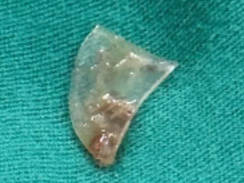 Bé gái ở TP.HCM khó thở suốt 4 tháng, gia đình bất ngờ khi biết lý do