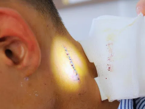 Nam thanh niên phải cấp cứu vì chủ quan với nốt mụn ở cổ