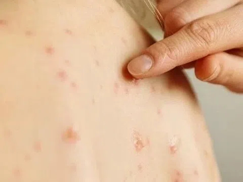 Trẻ bị thủy đậu có cần kiêng nước, kiêng tắm?