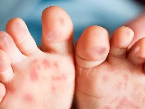 4 nguyên tắc ăn uống khi trẻ bị tay chân miệng