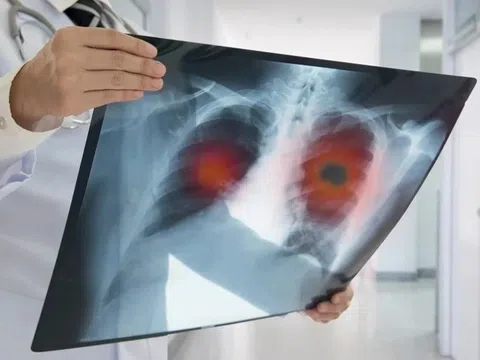 90% người bị ung thư phổi vì thói quen khó bỏ này