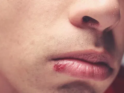 Những triệu chứng sớm của bệnh giang mai