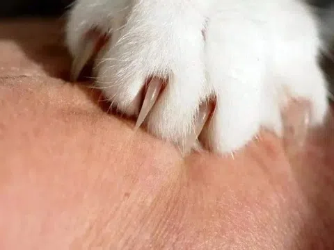 Người phụ nữ mắc bệnh dại sau khi bị mèo nhà nuôi cào