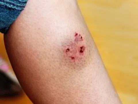 Bé gái tử vong vì bệnh dại do bị chó con cào