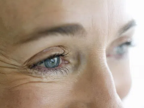 Vết chân chim là thứ không chị em nào thích, ngăn ngừa bằng cách nào?