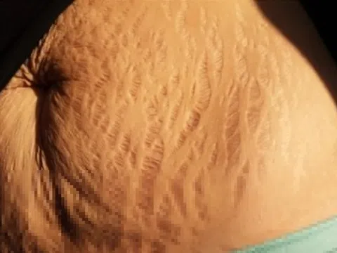 Câu chuyện xúc động sau hình ảnh da rạn khi mang thai