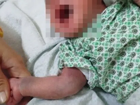 Ca sốt xuất huyết lây truyền từ mẹ sang con hiếm gặp