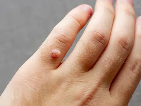 Loại virus rất phổ biến lây qua đường tình dục