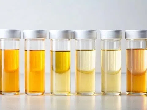 Màu sắc nước tiểu phản ánh gì về sức khỏe