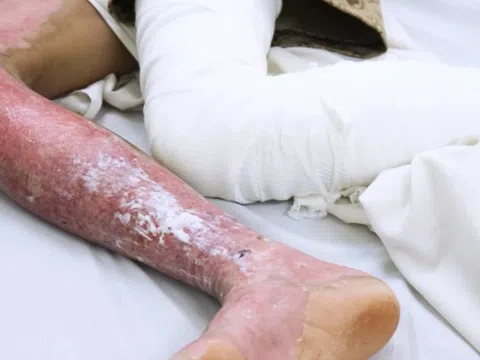 Nhiều trẻ bỏng nặng, vết thương nham nhở vì nghịch pháo