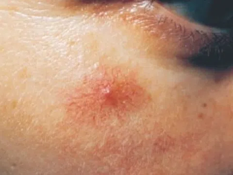 3 dấu hiệu bệnh gan biểu hiện ngay trên mặt