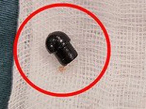 Bé trai 7 tuổi tử vong do hóc đầu bút bi