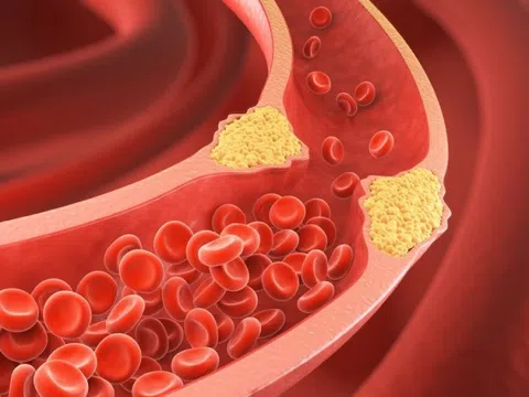 Vì sao người gầy cũng bị mỡ máu?