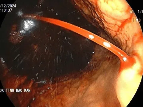 Máu phun thành tia trong dạ dày người đàn ông