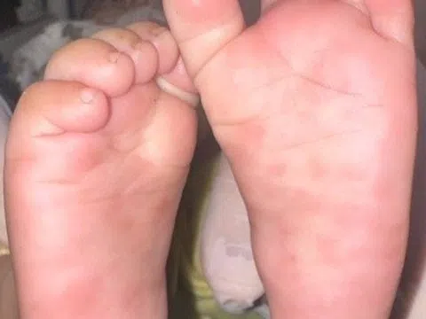 Bé 4 tháng tuổi mắc giang mai