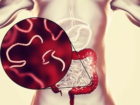 Dấu hiệu nhận biết bạn đã nhiễm giun kim