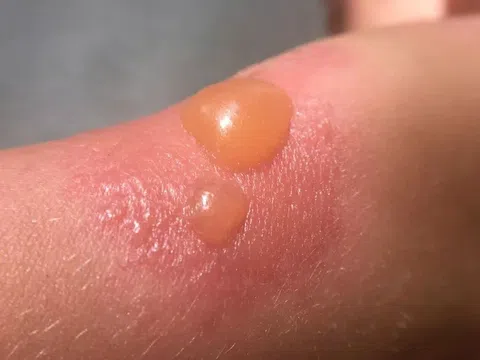 Trị phồng rộp da do cháy nắng