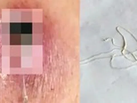 Phát hiện một ca mắc giun rồng, loại ký sinh trùng hiếm gặp dài hàng mét