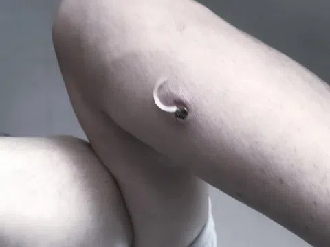 Giun rồng 'đục khoét' cơ thể người đàn ông