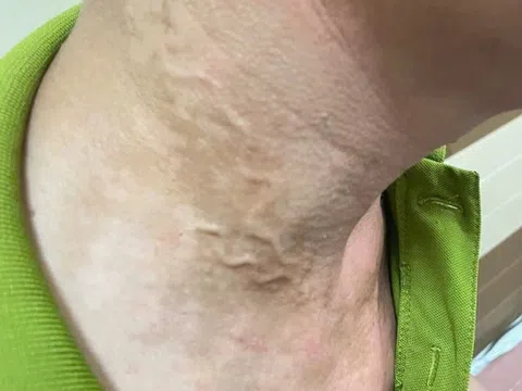 Giun nổi ngoằn ngoèo dưới da người đàn ông