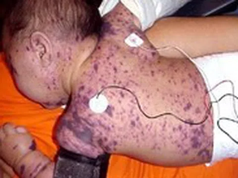 Bệnh não mô cầu dễ lây lan, nguy cơ xuất hiện thêm ca cộng đồng, phòng bệnh thế nào?