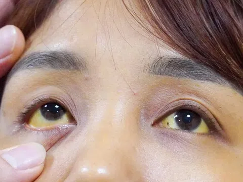 Gan bị hủy hoại vì nhiễm virus HBV
