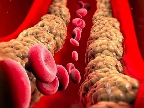 Không kiểm soát mỡ máu, điều gì xảy ra?