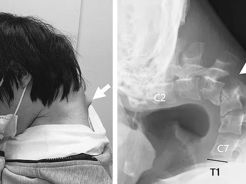 Hình ảnh cổ vẹo vọ đáng sợ của nam thanh niên vì sở thích quen thuộc