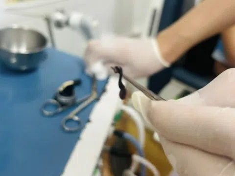 Gắp con đỉa dài 5 cm ký sinh trong mũi bé trai